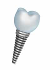 Implant Dentistry for patients in Lodi near Galt and Stockton