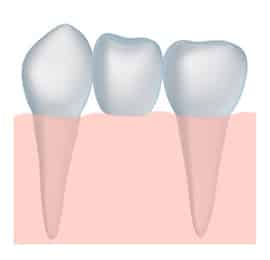 a Tooth Bridge can restore your smile to its former splendor, we serve the Stockton and Galt areas